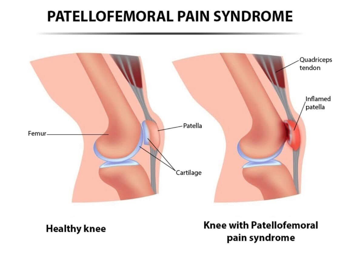 Patellofemoral pain syndrome (PFPS main image