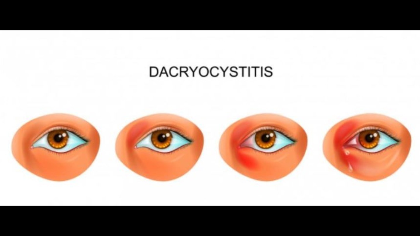 Dacryocystitis Treatment in Nagpur – Clear the Way for Healthy Tear Flow main image