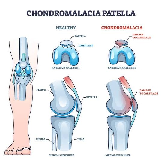Chondromalacia Patella – The Pain Behind Your Knee Cap! main image