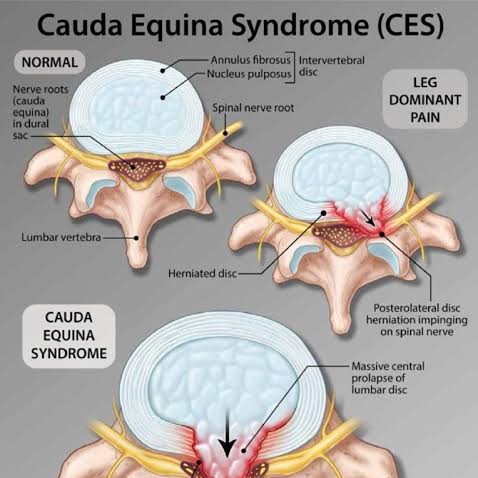 caudaequinasyndrome main image