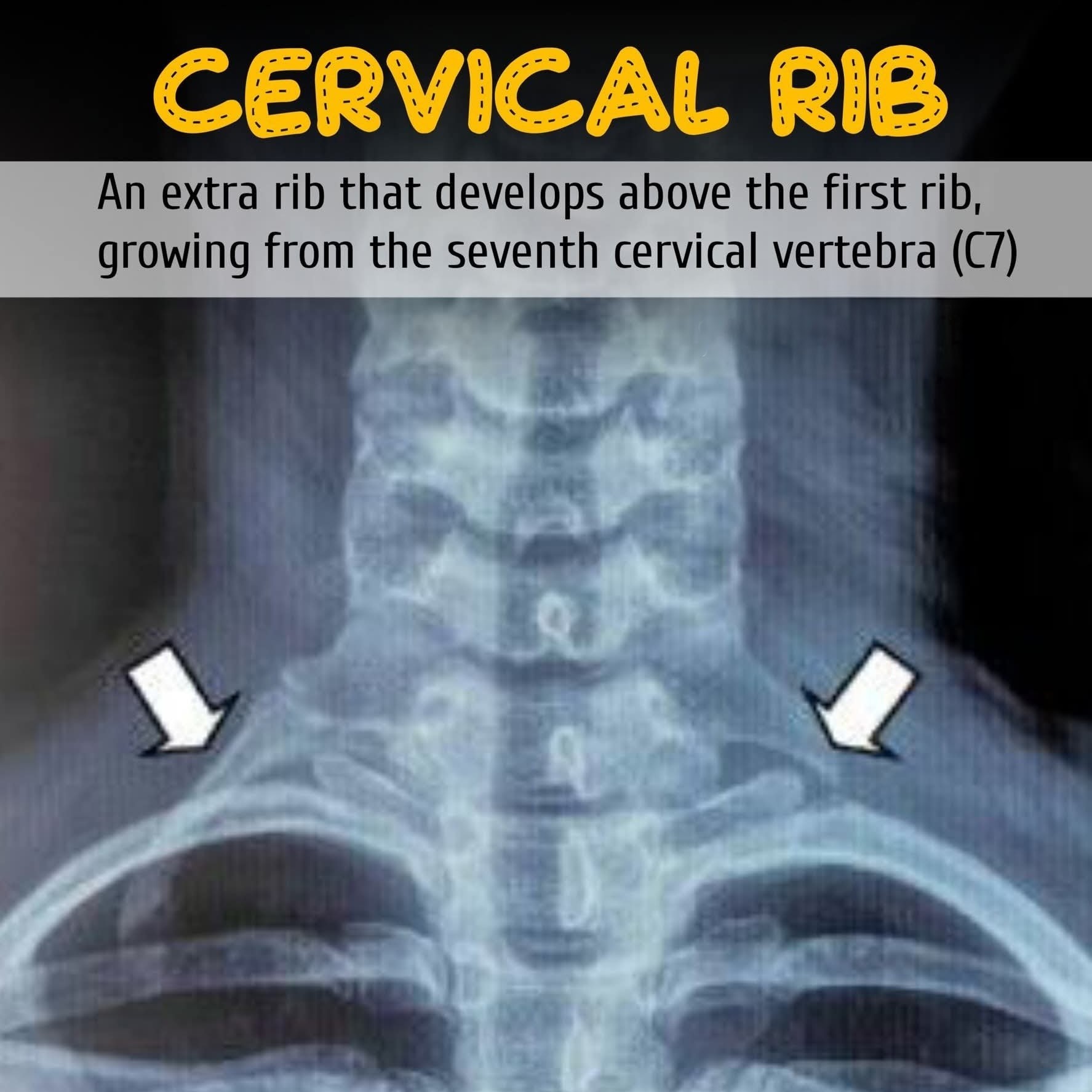 Cervical Rib – The Hidden Rib You Never Knew About main image