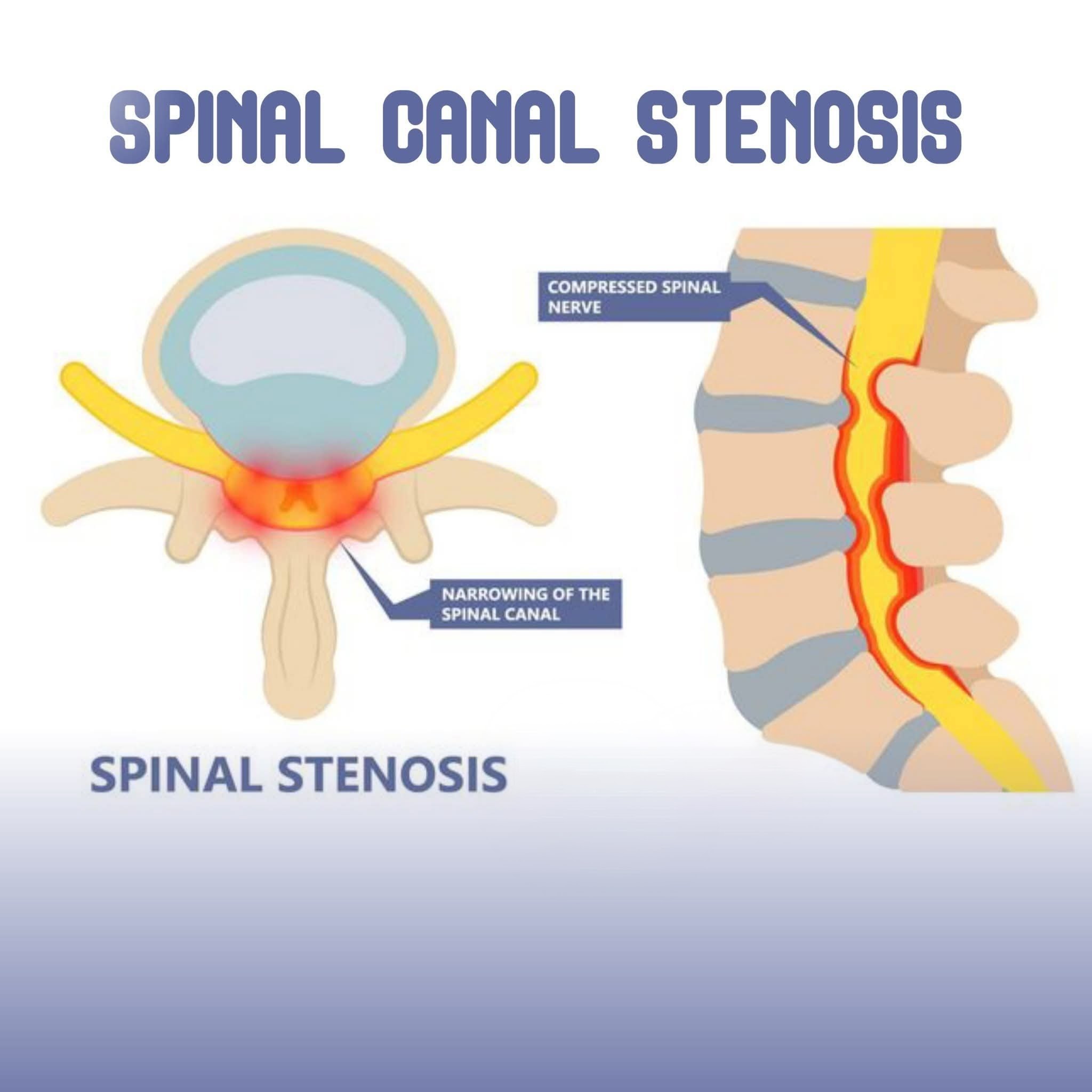 Spinal Canal Stenosis 🌟

A Comprehensive Overview for Awareness & Treatment 💡 main image