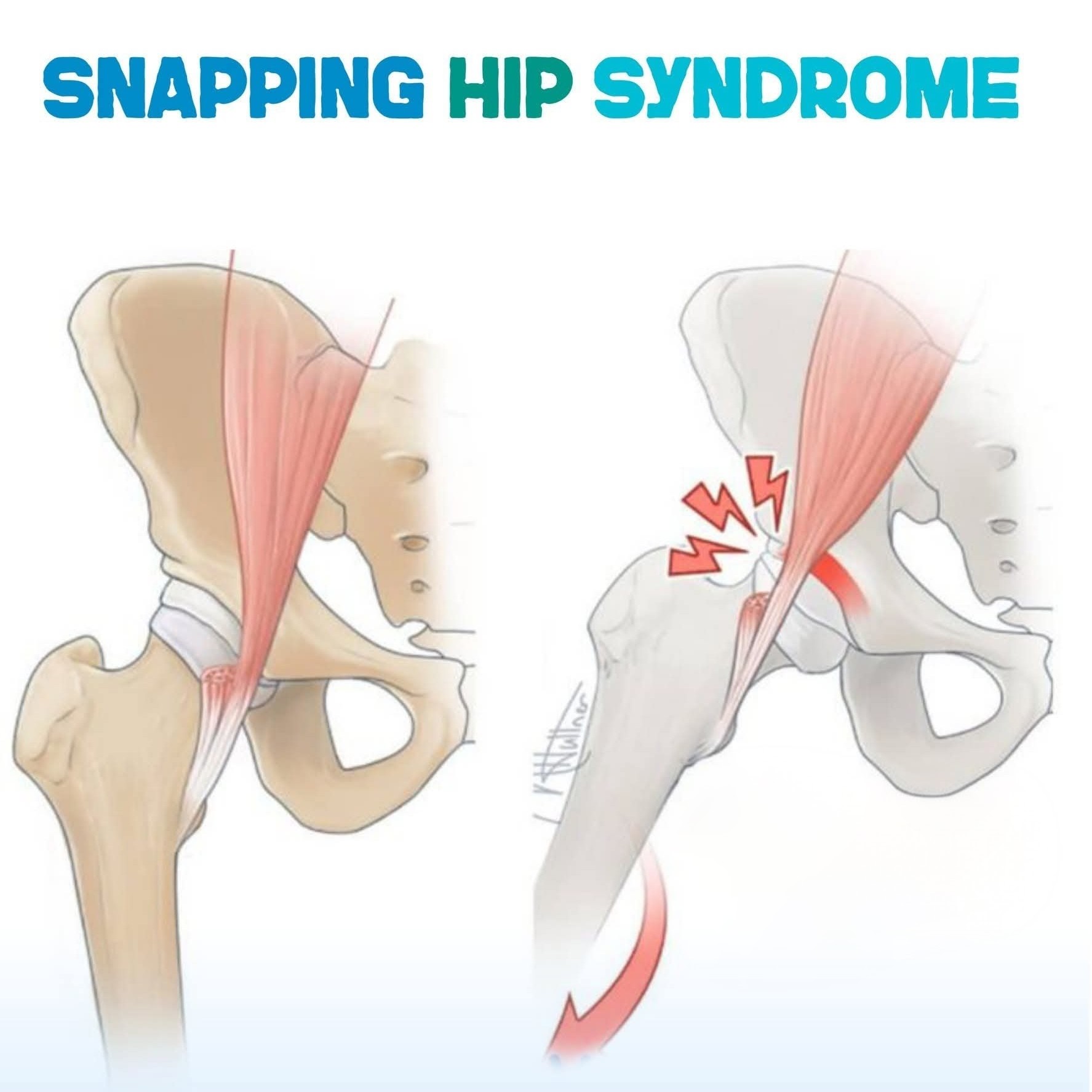 Snapping Hip Syndrome (SHS) main image