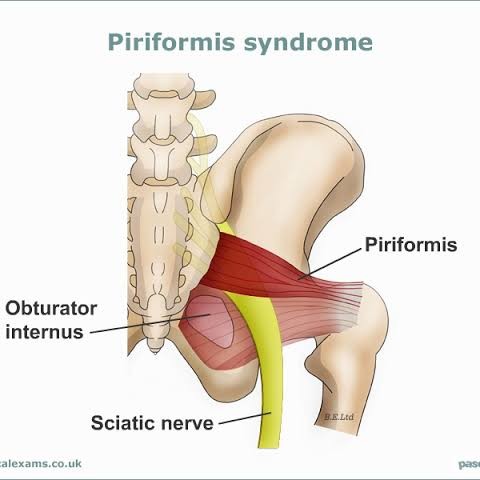 Piriformis syndrome main image