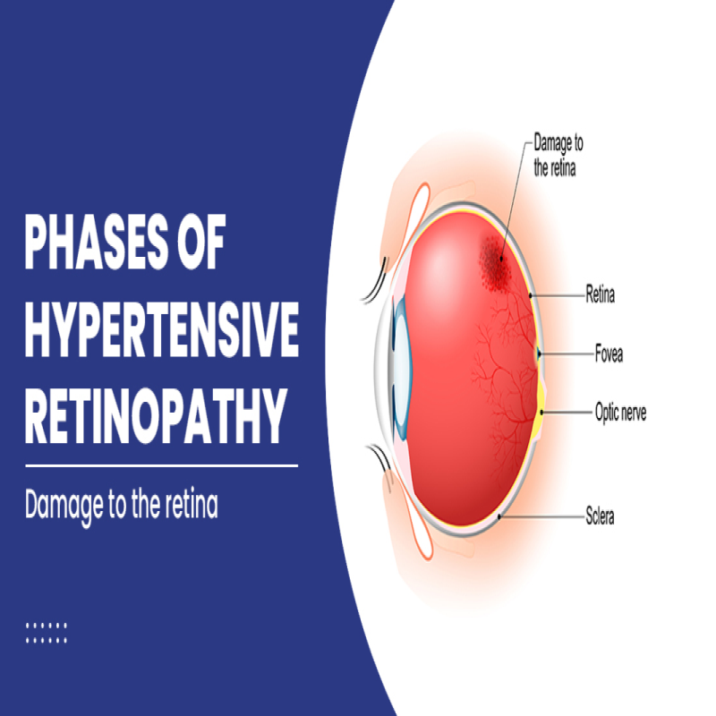Hypertensive Retinopathy Management in Nagpur – Protect Your Retina from High BP main image