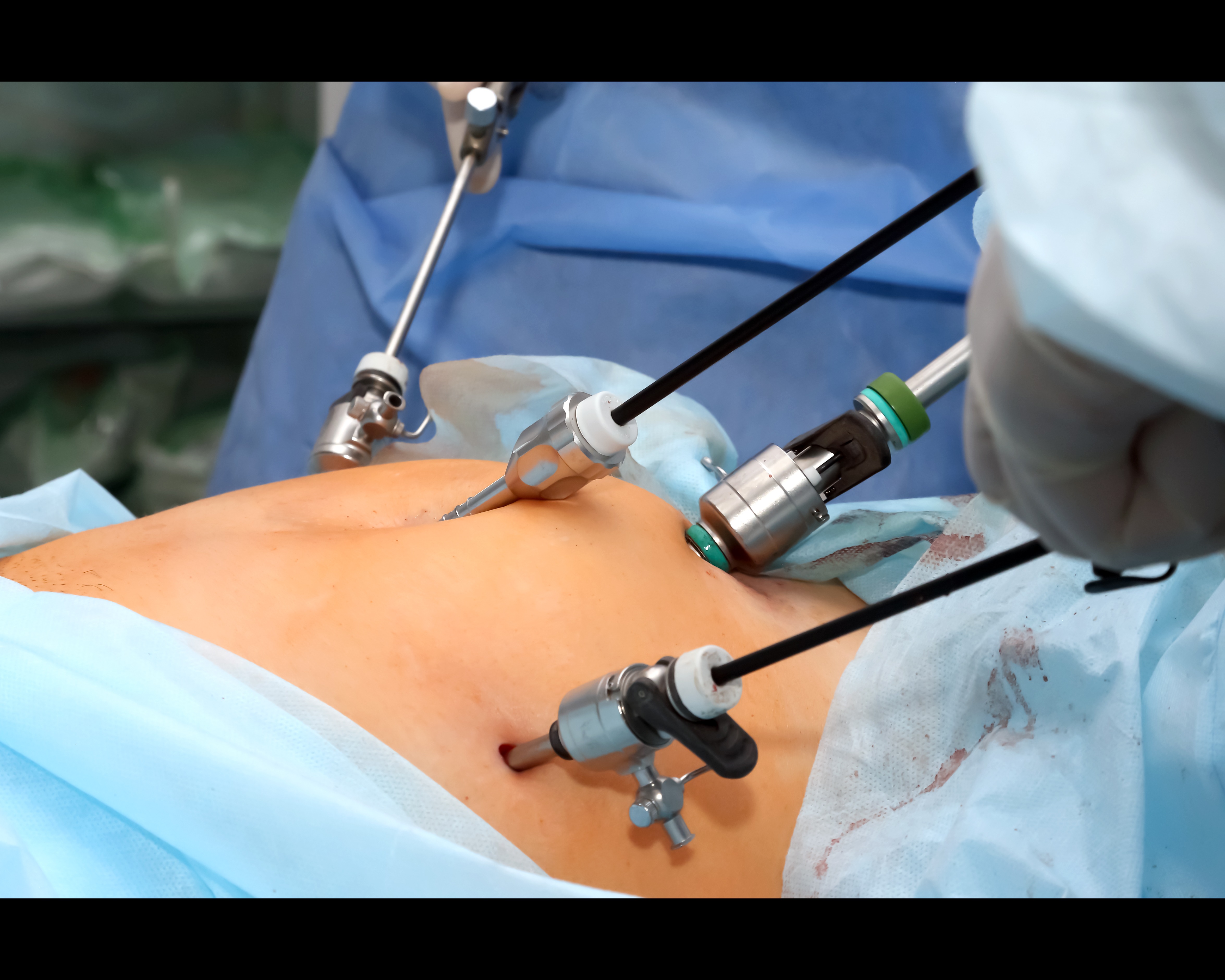 Key Hole Surgery in Chennai: Faster Recovery, Smaller Scars main image