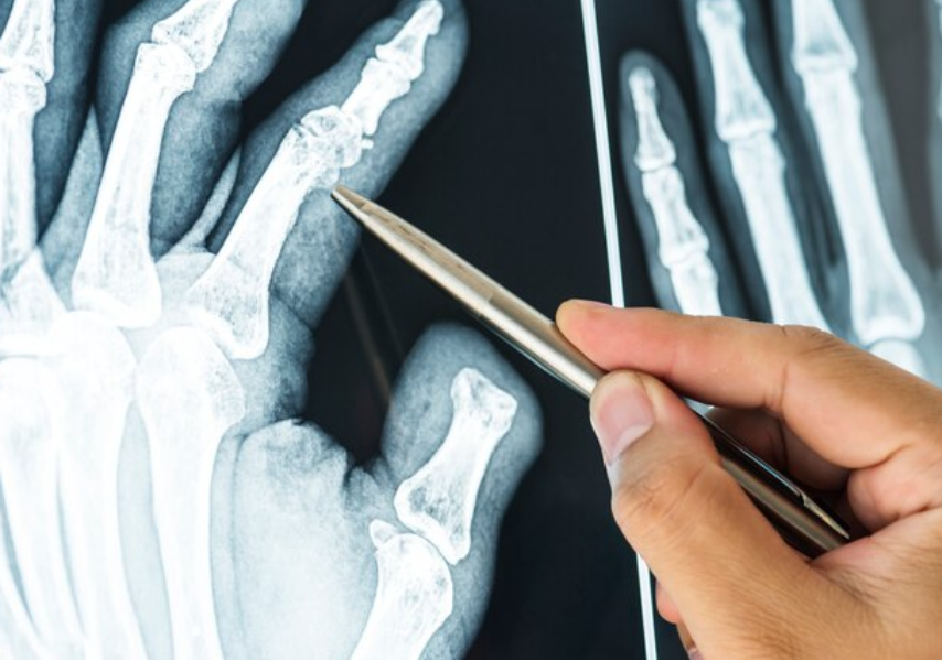 Bone Fracture Treatment in Avadi main image