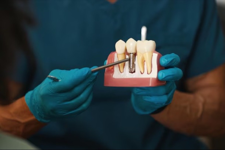 Nobel Biocare Implants in Delhi: Precision That Lasts   main image