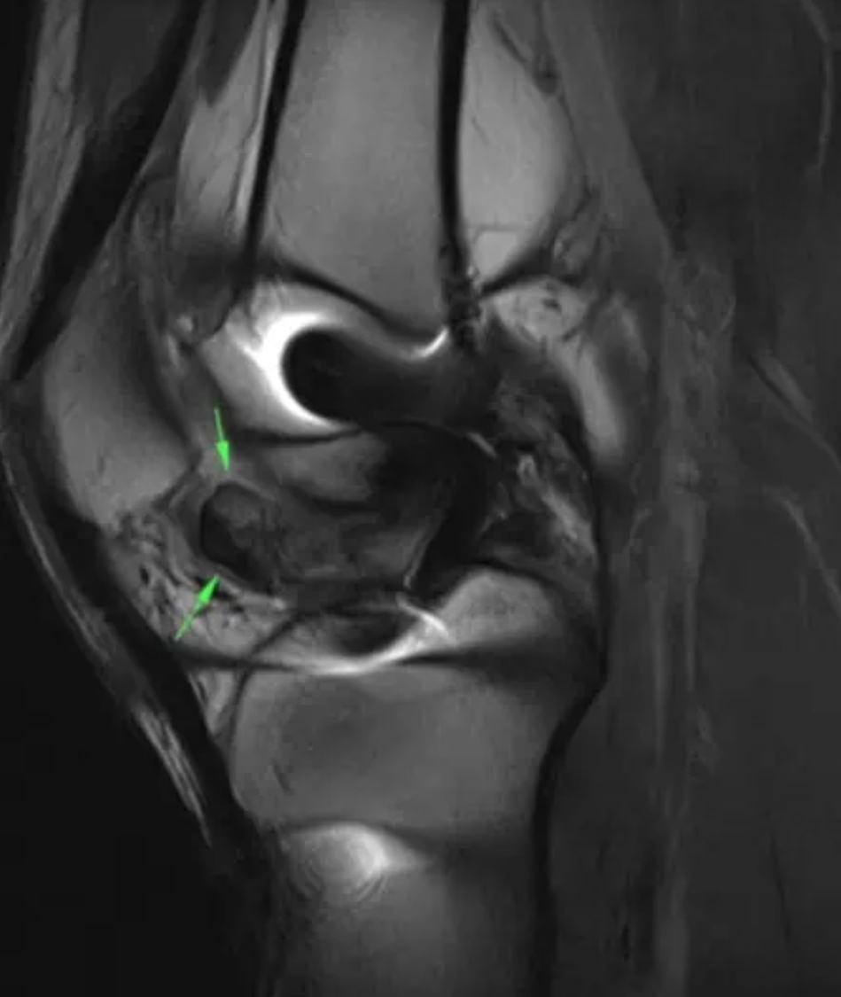 Loss of extension after ACL surgery: How to assess for a cyclops lesion main image