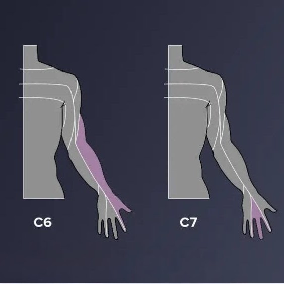 neck pain and its complications main image