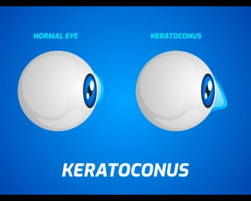 Keratoconus Diagnosis and Care in Nagpur – Protect Your Corneal Health main image