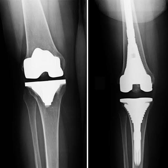 Here’s a detailed overview of Total Knee Replacement (TKR) and how physiotherapy main image