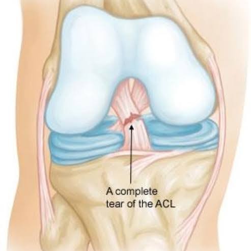 ACL Reconstruction Post-Operative Physiotherapy at Sunshine Super Speciality Physiotherapy Clinic – main image