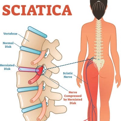 spinal conditions at the L5-S1 segment 🦴—from herniated discs and sciatica to degenerative disc dis main image
