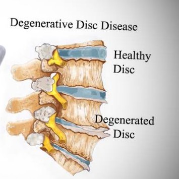 cervical degenerative disc disease main image