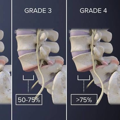 Aging-related degeneration of the facets and discs may make them less capable of bearing loads main image