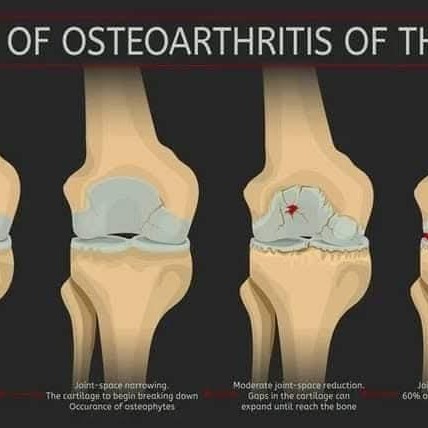 4 STAGES of Osteoarthritis: main image