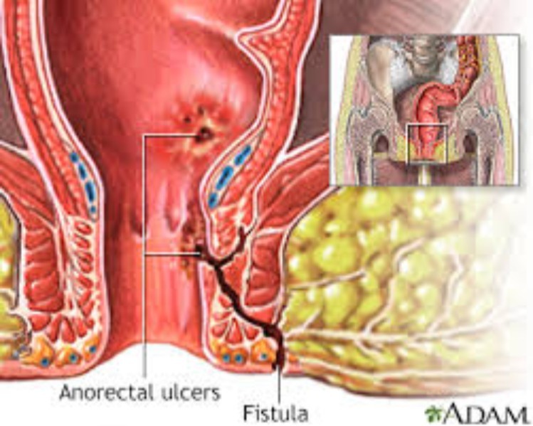 fistula clinic in trichy Malakar Ayur Care (MAC)  main image