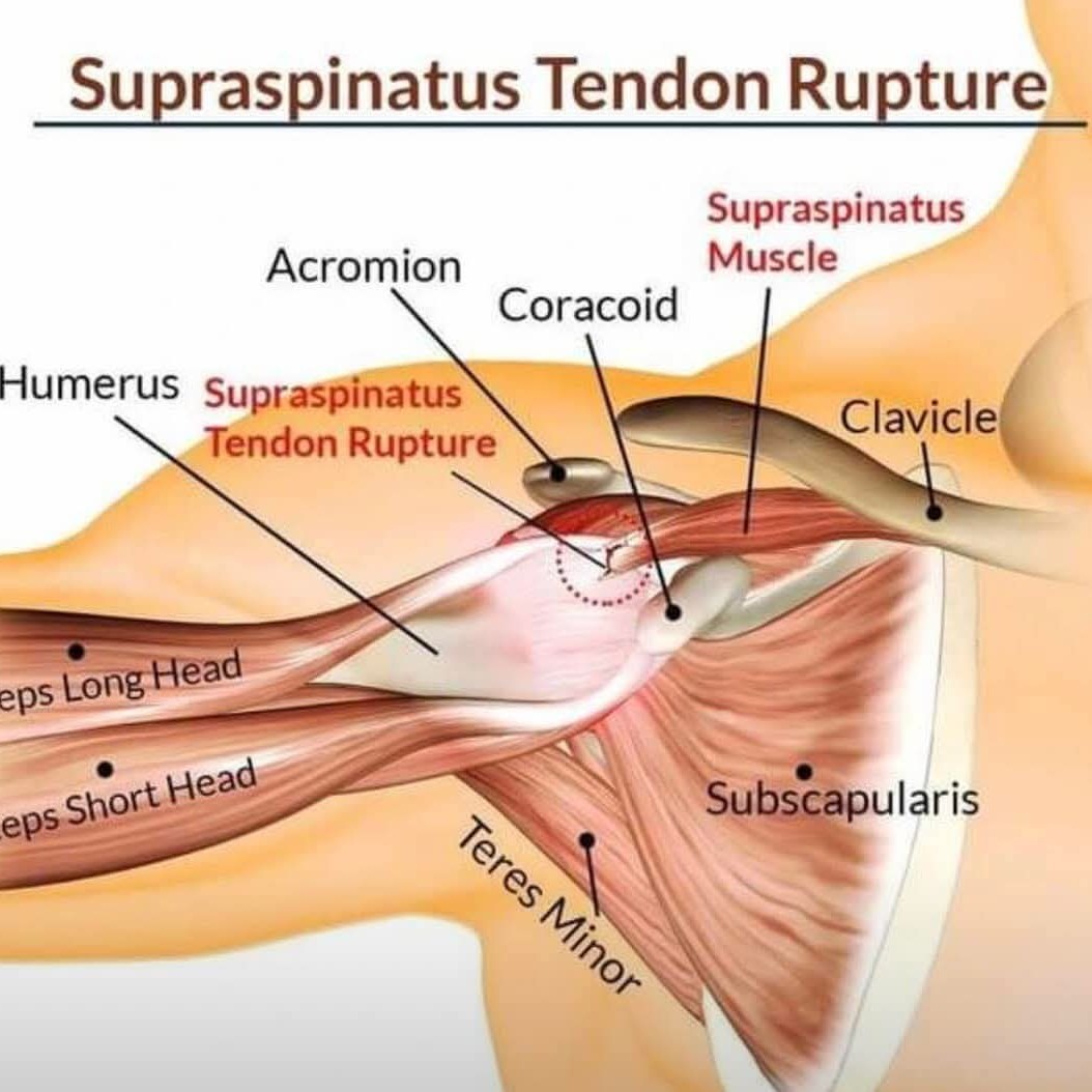 Supraspinatus Tendinopathy Treatment at Sunshine Super Speciality Physiotherapy Clinic main image