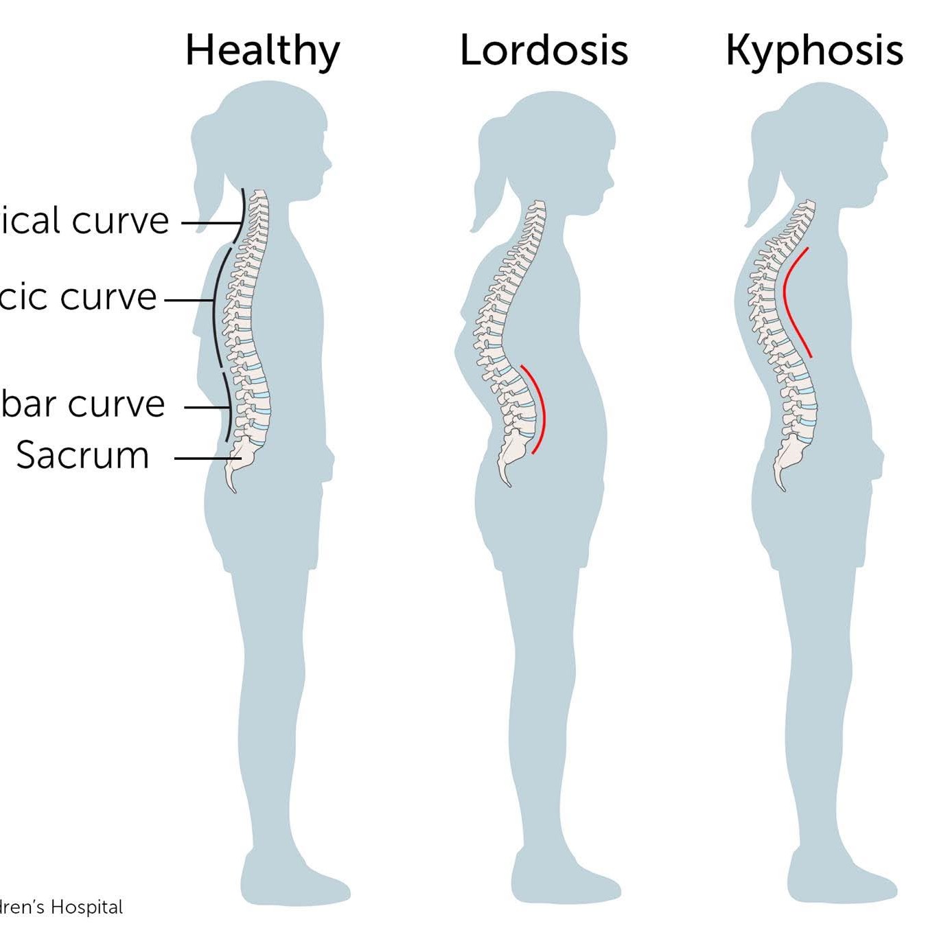 Spinal curvatures refer to the abnormal curves of the spine main image