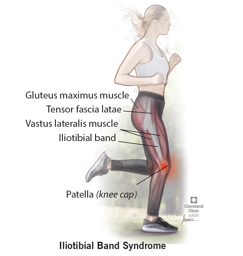 ILIOTIBIAL BAND SYNDROME


Treatment at Sunshine Super Speciality Physiotherapy Clinic main image