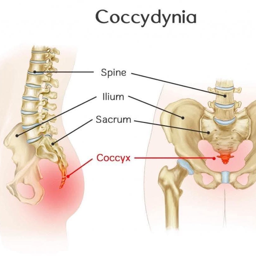 coccydynia Treatment at Sunshine Super Speciality Physiotherapy Clinic main image