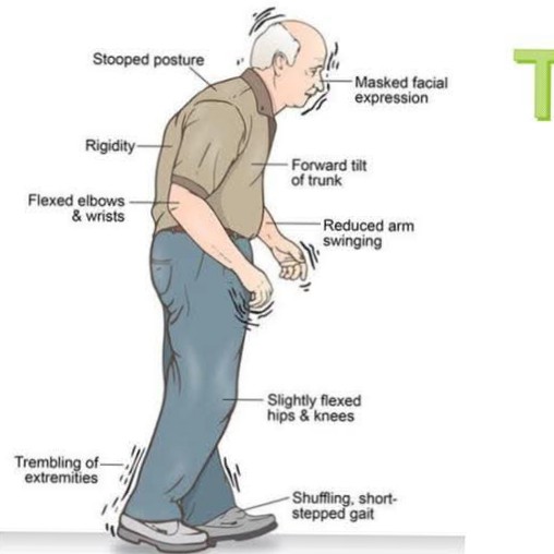 Parkinson’s disease Treatment at Sunshine clinic main image