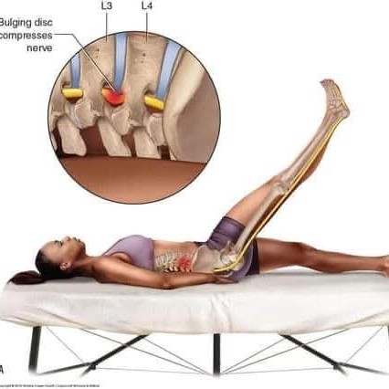 SPECIAL TEST|| STRAIGHT LEG RAISE TEST main image
