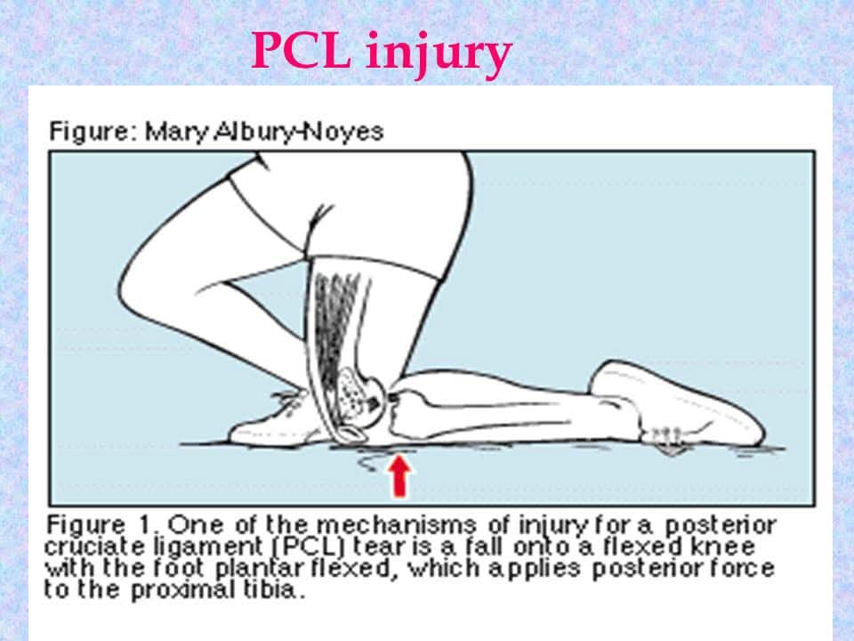 POSTERIOR CRUCIATE LIGAMENT TEAR Treatment at Sunshine clinic main image