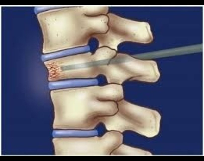 Osteoporotic Management with Vertebroplasties in Nagpur – Strengthening Fragile Bones main image