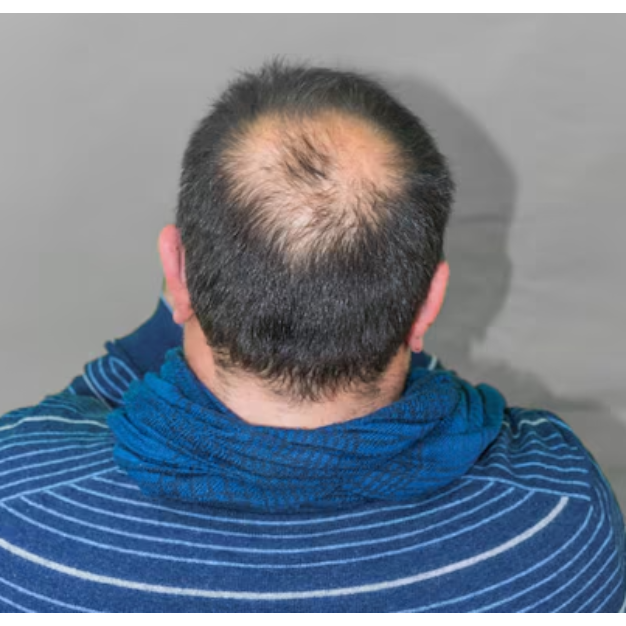 Male Pattern Baldness Treatment in Chennai – Understanding Long-Term Solutions main image