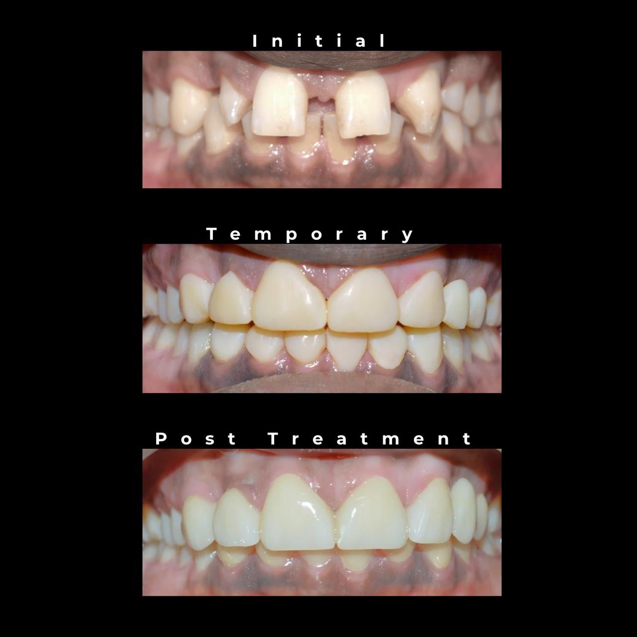 Digital dentistry has completely changed the way we plan and deliver smiles. In this case, we starte... main image
