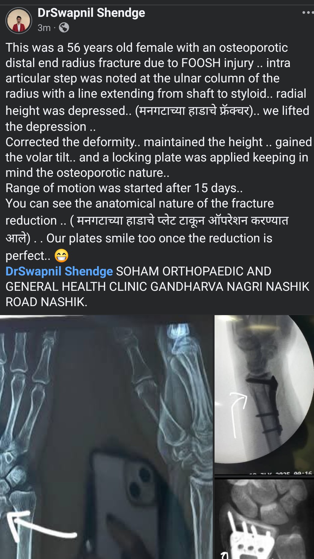 Another one of the cases operated by our esteemed surgeon Dr. Swapnil Shendge sir and Dr. Kalyani Sh... main image