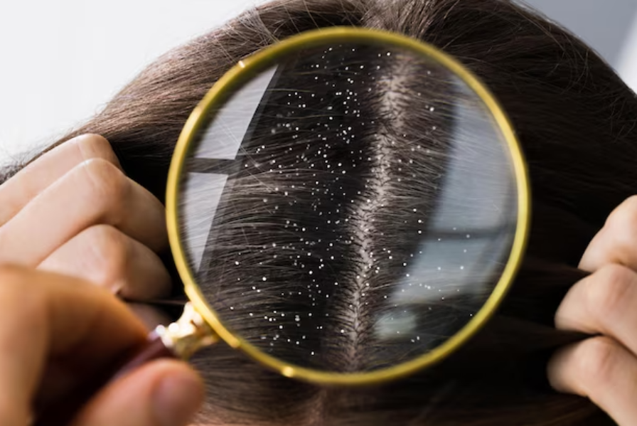 Dandruff Treatment in Chennai – Stop the Itch and Flakes for Good main image