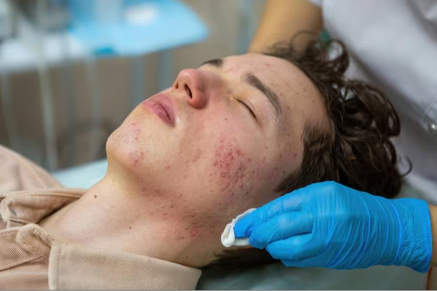 Acne and Acne Scars Treatment in MRC Nagar – Clear Skin, Renewed Confidence main image
