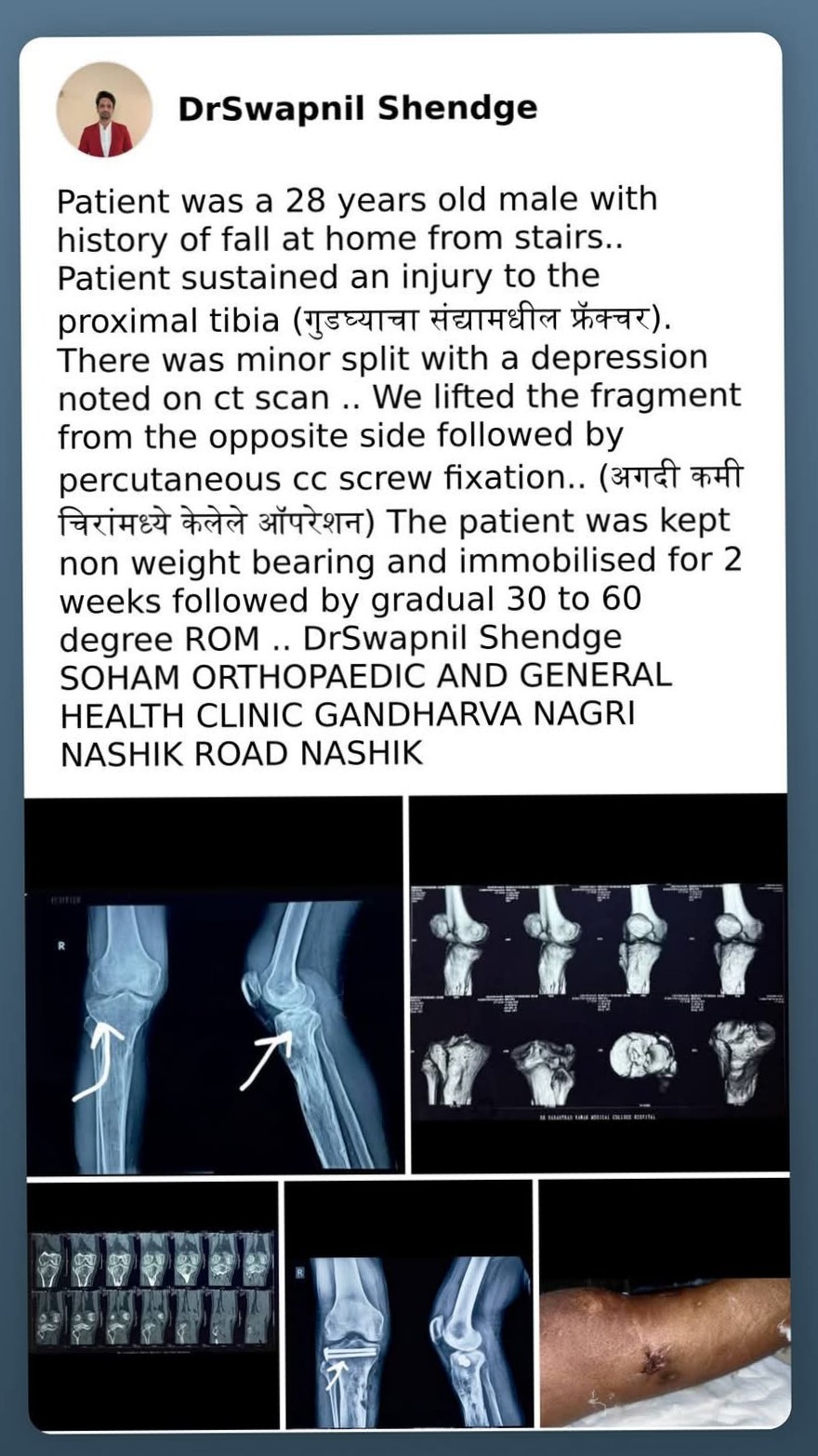 An exceptional case done by our surgeon Dr. Swapnil Shendge sir with minimally invasive techniques..... main image