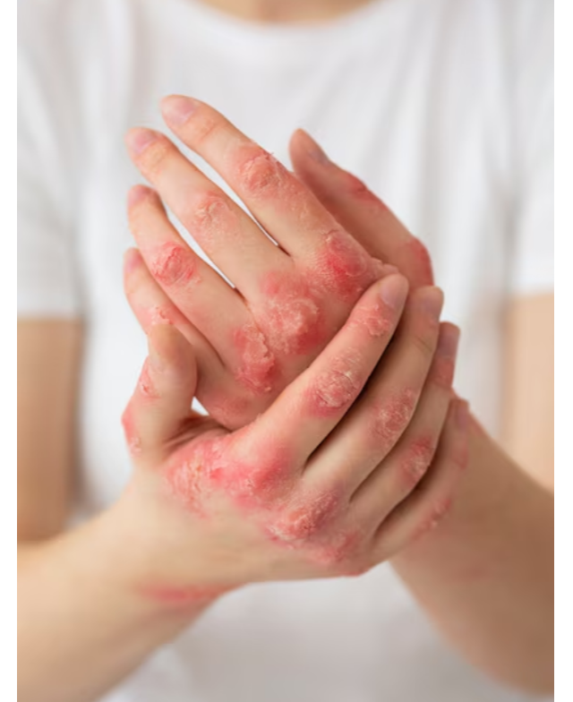 Ayurvedic Medicine for Eczema in Pune – Gentle Relief, Lasting Comfort main image