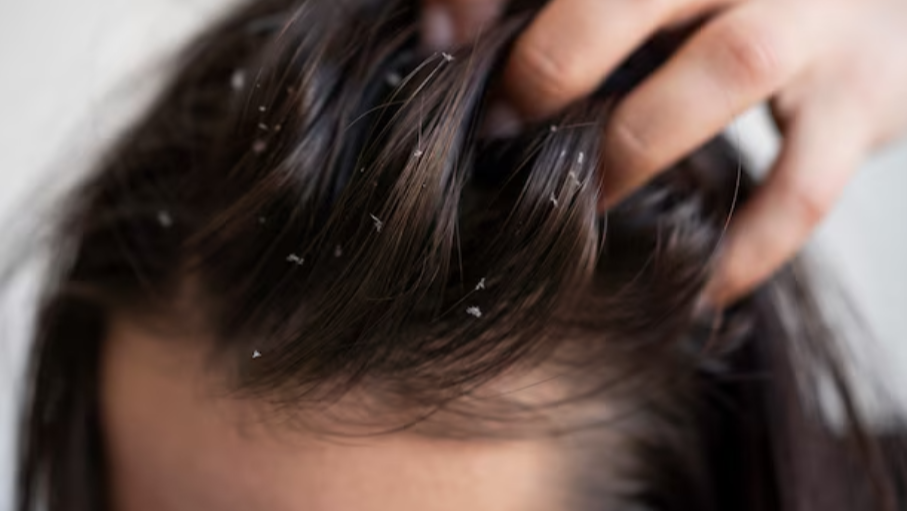 Best Anti Dandruff Shampoo in Chennai – Choosing What Actually Works main image