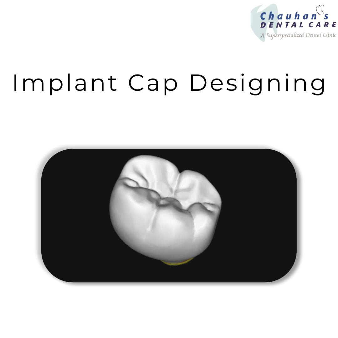 From scan to smile– Digital workflow for implant cap designing.
Each step ensures precision, accurac... main image