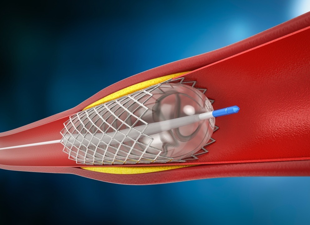 Best Angiography and Angioplasty Services in Nashik main image
