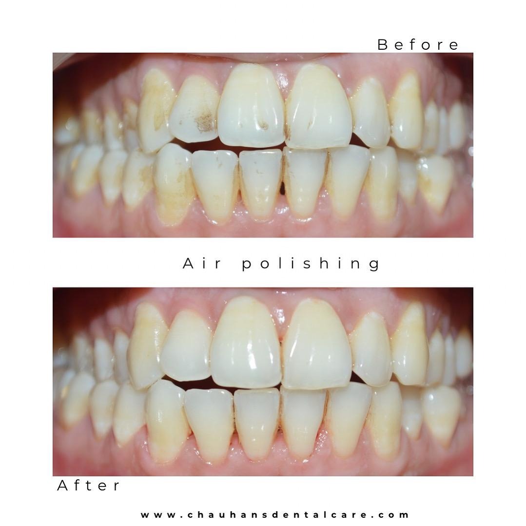 Love coffee or tea but hate the stains it leaves behind? 
Air Polishing is the secret to bringing ba... main image