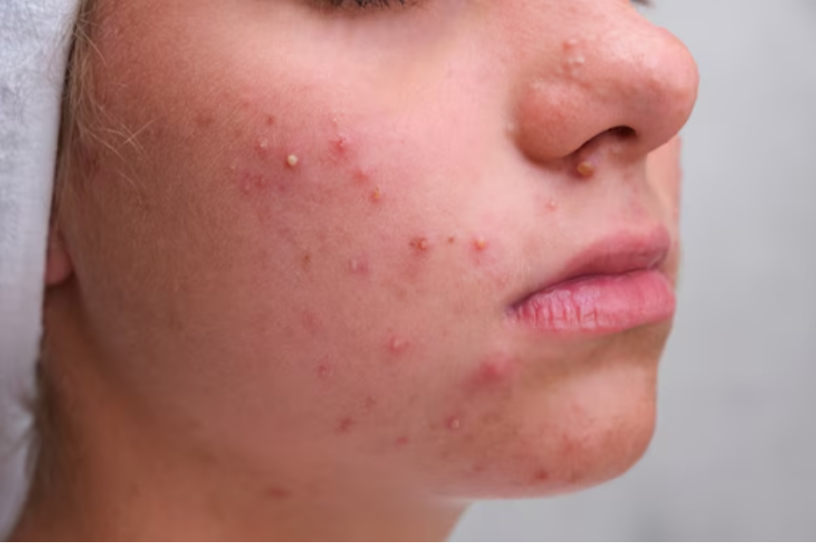 Best Ayurvedic Medicine for Pimples in Pune – Clear Skin the Natural Way main image
