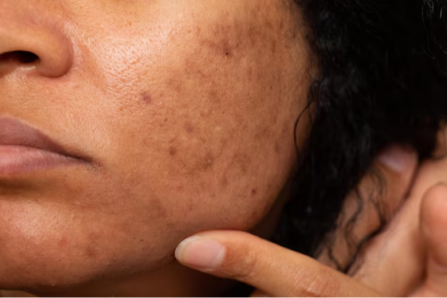 Ayurvedic Treatment for Pigmentation in Pune – Restore Even Skin Tone Naturally main image