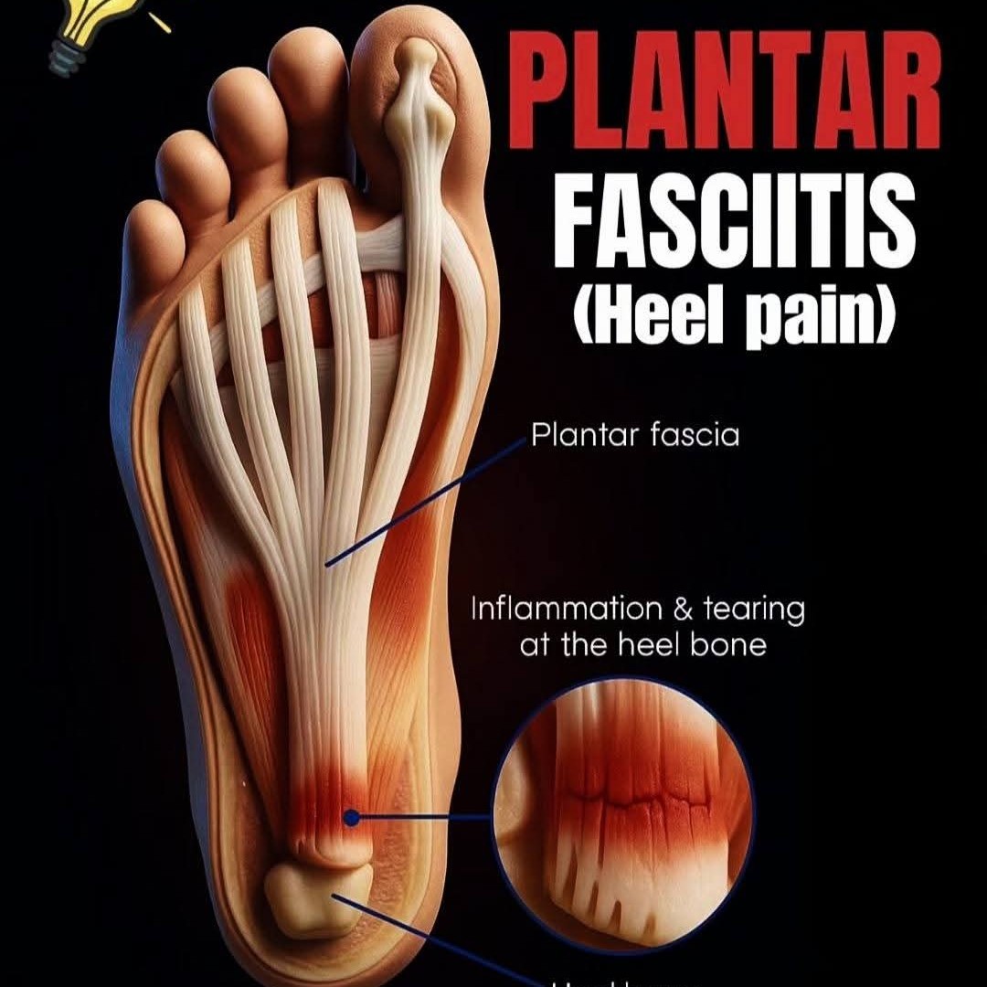 plantar fasciitis and treatment at Sunshine clinic main image