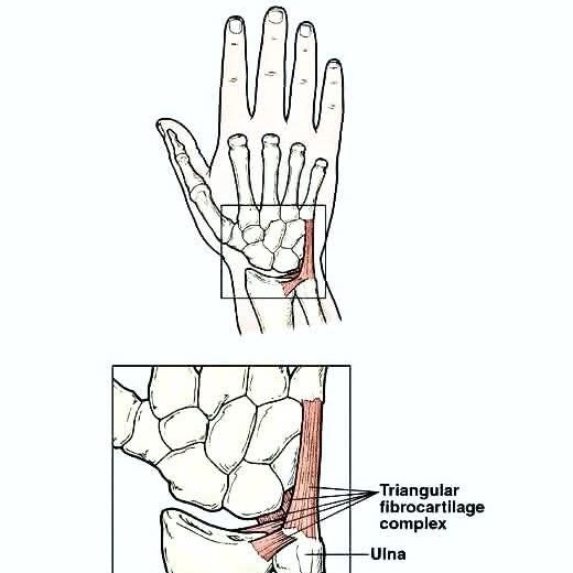 Triangular Fibrocartilage Complex (TFCC) Tears: main image