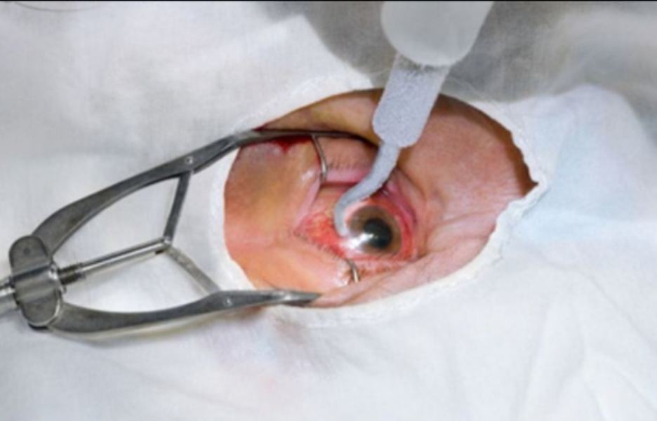 Phacoemulsification in Nagpur – Modern Cataract Surgery Technique main image