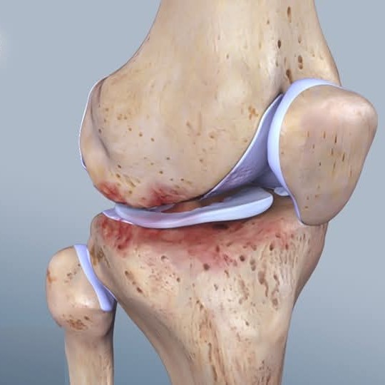 Osteoarthritis knee and hip joint treatment at Sunshine clinic main image
