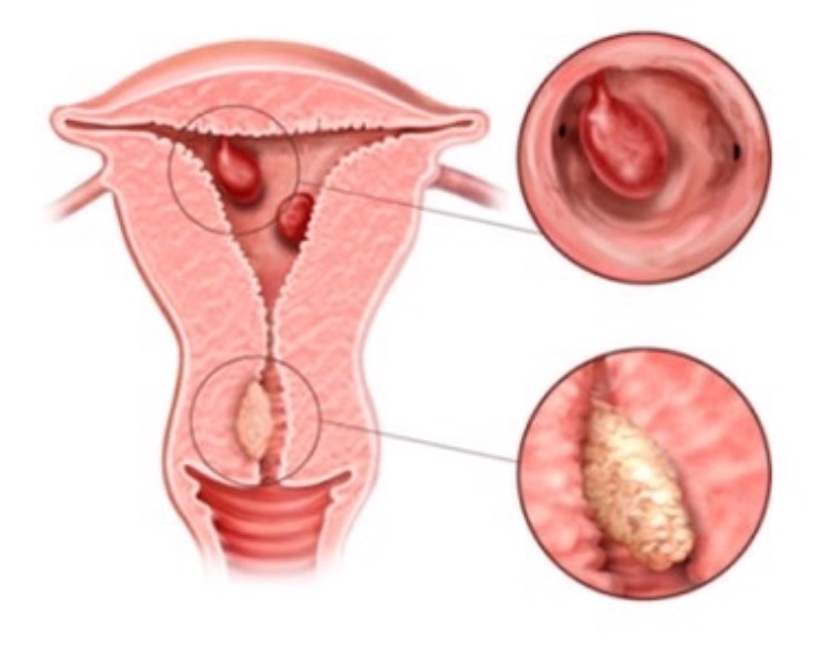 Hysteroscopic Polypectomy ! main image
