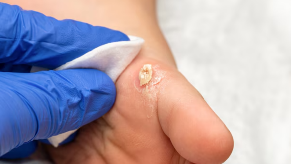 Wart Removal in Chennai – Safe and Effective Solutions main image
