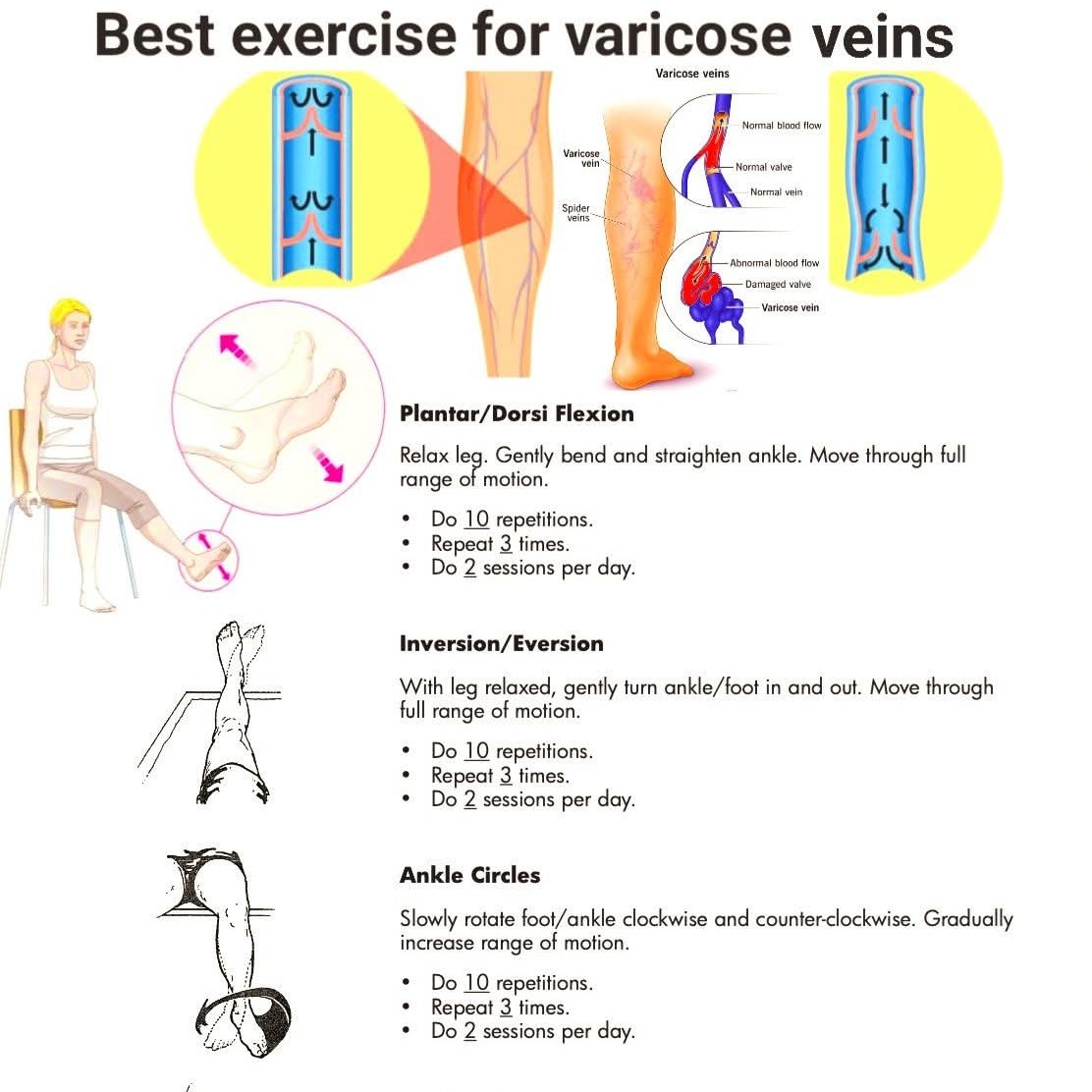 Best exercise for varicose veins and Treatment at Sunshine Super Speciality Physiotherapy Clinic main image